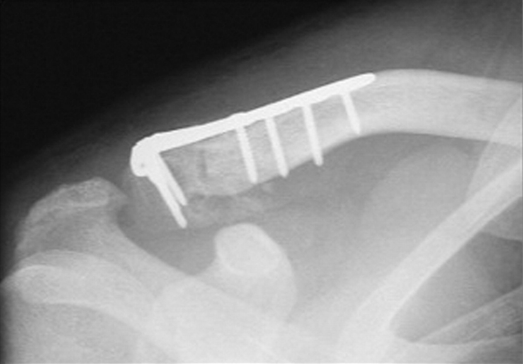 Tratamentul fracturii de claviculă – Dr. Mihai Tudor Gavrila