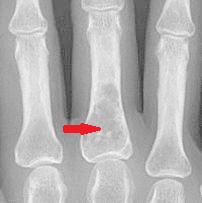 dureri articulare degetul mare la mers durere în articulația șoldului cu febră