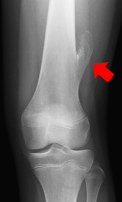Exostoze osteogenice Exostoza la genunchi de ce durere