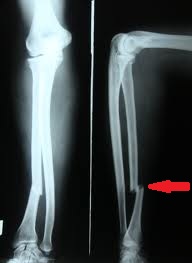 artroza tratamentului articulației stângi care medicul tratează durerea în articulația cotului