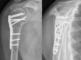 radiografie fractura umar