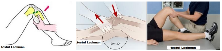 tratamentul sindromului sertarului genunchiului