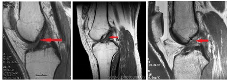 Diagnosticul RMN al leziunilor la genunchi