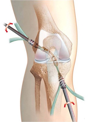 reparație rapidă a ligamentului genunchiului)