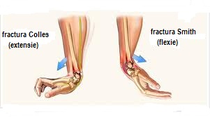 fractura articulatie mana