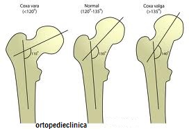 fractura de col femural artroza tratamentului în stadiul inițial al genunchiului