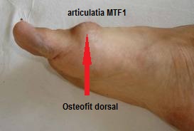 artroza piciorului articulației)