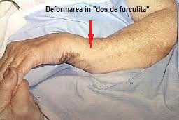 consecințe ale inflamației genunchiului articulațiile rănesc stricate