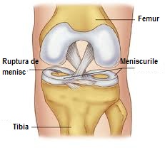 Deteriorarea meniscului medial al sinovitei articulației genunchiului drept