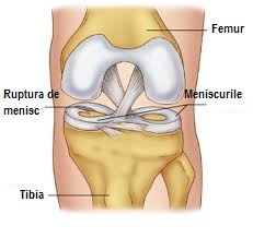 concediu medical ruptura de menisc