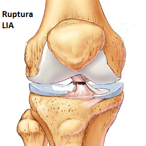 tratament de fibrilatie a ligamentului genunchiului)