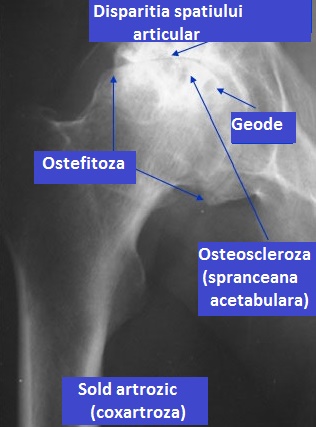 artroza coxofemurala bilaterala articulația șoldului cum să tratezi