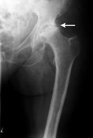 semne radiologice ale artrozei articulației șoldului