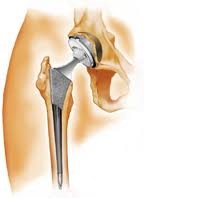 Artroza gradului 3 al tratamentului articulației genunchiului, Gradul 3 artroza genunchiului