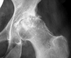 dureri normale de radiografie a articulației șoldului acolo)
