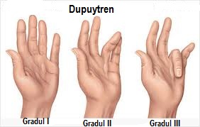 articulațiile de pe degete sunt îngroșate decât tratate endocrinolog dureri de articulații