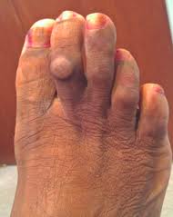 tratamentul artrozei falangei degetelor de la picioare)
