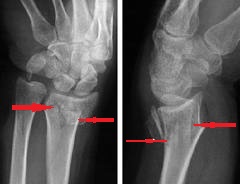 Tratamentul fracturii de pumn (fractura de epifiză distală de radius)