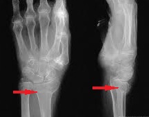 Fractura de epifiza distala de radius