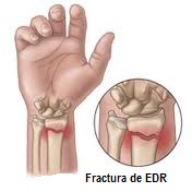 Fractura mana