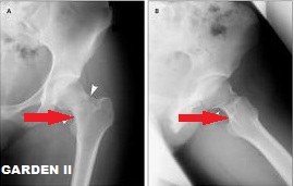 tratamentul fracturilor de șold cauze ale durerii articulare a genunchiului