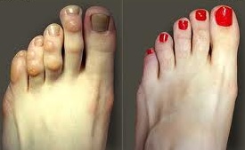 artrita falangei degetelor de la picior)