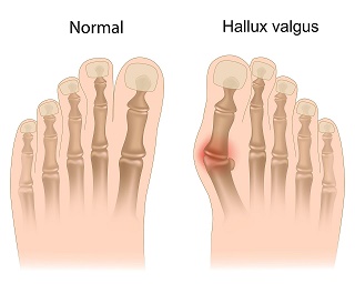 METATARSALGIA - CAUZE, SIMPTOME, TRATAMENT