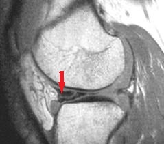 ruptura corn posterior menisc intern