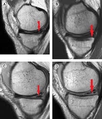 deteriorarea coarnelor posterioare ale meniscului articulației genunchiului