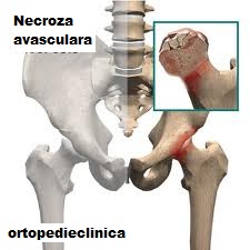 tratamentul osteosclerozei genunchiului subcondral)