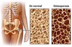 osteoporoză pentru pierderea în greutate