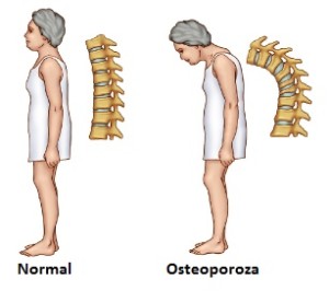 osteoporoza difuza)