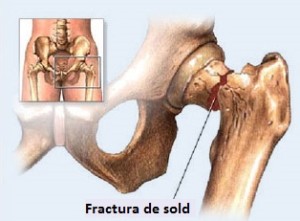 Osteoporoza: cauze, simptome si tratament | staruri.ro