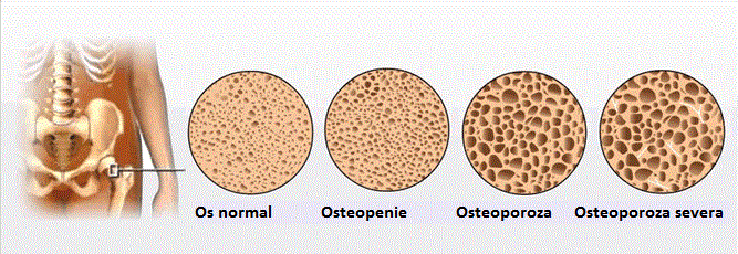 Osteoporoza difuză: semne și tratament