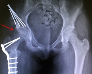 Artroza a 2-a etapă a articulației gleznei ,spatele doare ce înseamnă