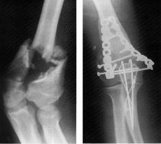 tratamentul fracturilor de condil condil