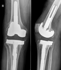 gonartroza simptomelor tratamentului articulației genunchiului determină metode
