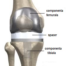 perspective de tratament cu artroză artroza articulației genunchiului drept 3 grade