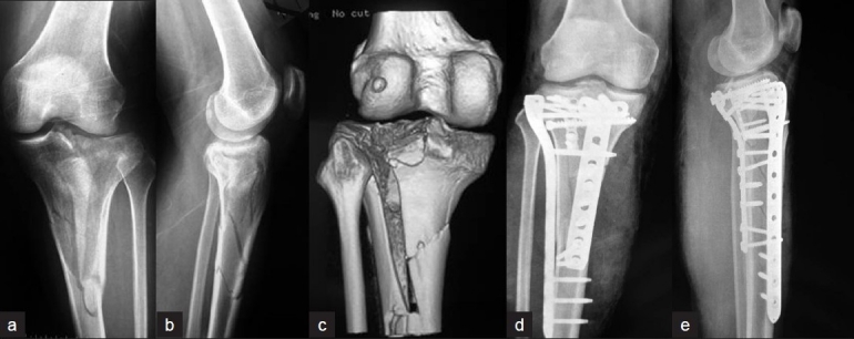 blocarea articulațiilor cu artroza condroprotectoare pentru artroza condroitinei genunchiului