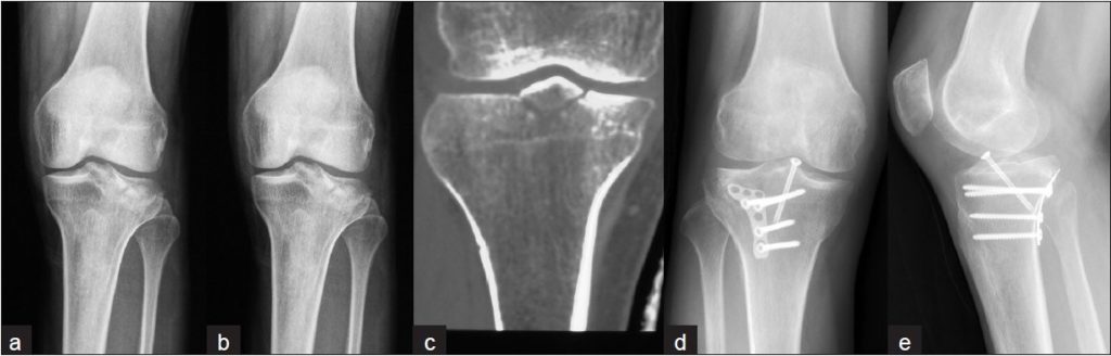 scleroza plăcii subcondrale a tratamentului articulației genunchiului