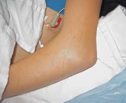 tratamente pentru entorsa cotului recomandări pentru artroza articulației gleznei