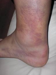 picior umflat si tare la pulpa | Forumul Medical ROmedic