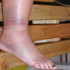 Umflarea picioarelor in cancer – cauze si tratament - Umflarea gleznei cum să bandajeze