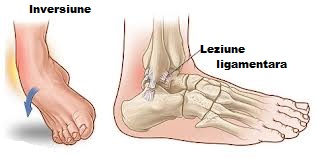 Entorsele: entorsa glezna, genunchi - Simptome, tratament, recuperare