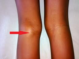 tratamentul genunchiului ganglionului