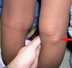 umflatura in spatele genunchiului cauze