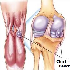 Chistul Becker în articulația genunchiului și durerea