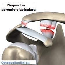 leziuni articulare acromioclaviculare)