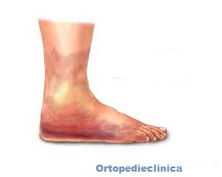 Genunchi umflat: Umflarea piciorului și piciorului după înlocuirea genunchiului,