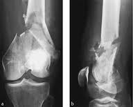 anchiloza osoasa noi tratamente pentru articulațiile picioarelor